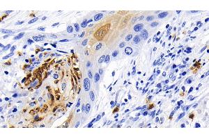 Detection of CASP1 in Human Lung cancer Tissue using Polyclonal Antibody to Caspase 1 (CASP1)