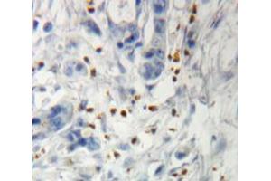IHC-P analysis of pancreas tissue, with DAB staining. (IGF2BP3 anticorps  (AA 2-343))