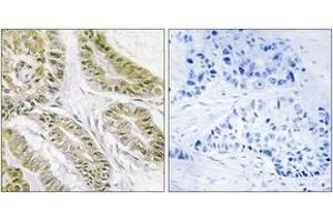 Immunohistochemistry analysis of paraffin-embedded human lung carcinoma tissue, using BAX Antibody. (BAX anticorps  (AA 80-129))