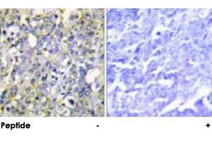 Immunohistochemical analysis of paraffin-embedded human lung carcinoma tissue using IGFBP3 polyclonal antibody . (IGFBP3 anticorps  (Ser183))