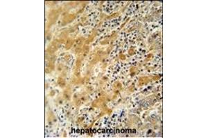 NUS antibody (N-term) 11000a immunohistochemistry analysis in formalin fixed and paraffin embedded human hepatocarcinoma followed by peroxidase conjugation of the secondary antibody and DAB staining. (NUSAP1 anticorps  (N-Term))