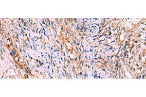Immunohistochemistry of paraffin-embedded Human cervical cancer tissue using GALK2 Polyclonal Antibody at dilution of 1:95(x200) (GALK2 anticorps)