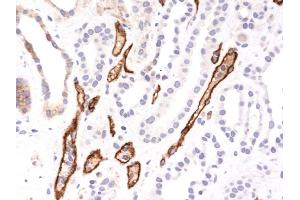 Formalin-fixed, paraffin-embedded human Hepatocellular Carcinoma stained with Complement 4d Mouse Monoclonal Antibody (C4D204). (C4A anticorps)