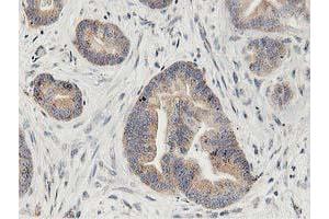 Immunohistochemical staining of paraffin-embedded Adenocarcinoma of Human colon tissue using anti-LGR5 mouse monoclonal antibody. (LGR5 anticorps  (AA 250-550))
