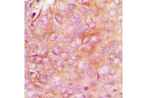 Immunohistochemical analysis of STMN1 (pS16) staining in human breast cancer formalin fixed paraffin embedded tissue section. (Stathmin 1 anticorps  (N-Term, pSer16))