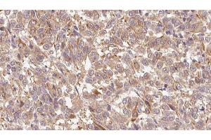 ABIN6279695 at 1/100 staining Human Melanoma tissue by IHC-P. (S100A7 anticorps  (C-Term))