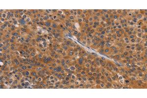 Immunohistochemistry of paraffin-embedded Human liver cancer tissue using NCR1 Polyclonal Antibody at dilution 1:30 (NCR1 anticorps)