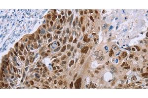 Immunohistochemistry of paraffin-embedded Human esophagus cancer using MAGEA10 Polyclonal Antibody at dilution of 1:50 (MAGEA10 anticorps)