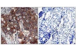 Immunohistochemical analysis of paraffin- embedded human breast carcinoma tissue using HER2 (Ab-877) antibody (E021070). (ErbB2/Her2 anticorps)