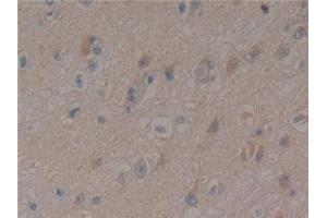 Detection of PXN in Human Glioma Tissue using Polyclonal Antibody to Paxillin (PXN)