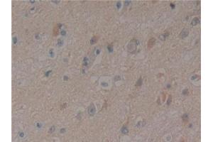 Detection of PXN in Human Glioma Tissue using Polyclonal Antibody to Paxillin (PXN) (Paxillin anticorps  (AA 201-461))
