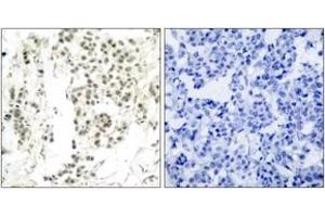 Immunohistochemistry analysis of paraffin-embedded human breast carcinoma, using Chk1 (Phospho-Ser345) Antibody. (CHEK1 anticorps  (pSer345))