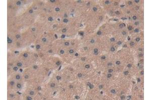 Detection of RSPO1 in Human Liver cancer Tissue using Polyclonal Antibody to R-Spondin 1 (RSPO1)