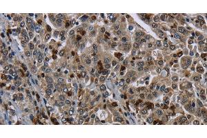 Immunohistochemistry of paraffin-embedded Human liver cancer tissue using CD42b Polyclonal Antibody at dilution 1:50