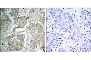Immunohistochemistry analysis of paraffin-embedded human breast carcinoma, using VEGFR2 (Phospho-Tyr1214) Antibody. (VEGFR2/CD309 anticorps  (pTyr1214))