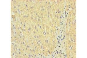 Immunohistochemistry of paraffin-embedded human liver cancer using ABIN7158295 at dilution of 1:100 (LAIR2 anticorps  (AA 22-152))