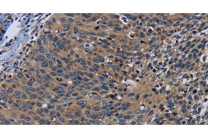 Immunohistochemistry of paraffin-embedded Human cervical cancer tissue using PCDHB15 Polyclonal Antibody at dilution 1:50 (PCDHB15 anticorps)