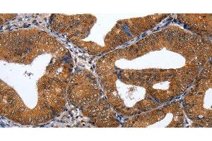 Immunohistochemistry of paraffin-embedded Human cervical cancer tissue using GATA6 Polyclonal Antibody at dilution 1:35 (GATA6 anticorps)