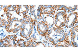 Immunohistochemistry of paraffin-embedded Human thyroid cancer tissue using ALDH5A1 Polyclonal Antibody at dilution 1:60 (ALDH5A1 anticorps)
