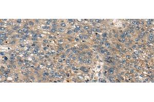 Immunohistochemistry of paraffin-embedded Human liver cancer tissue using CDKL2 Polyclonal Antibody at dilution of 1:25(x200) (CDKL2 anticorps)