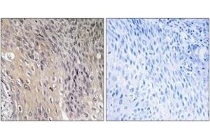 Immunohistochemistry analysis of paraffin-embedded human cervix carcinoma, using ARHGDIA (Phospho-Ser174) Antibody. (ARHGDIA anticorps  (pSer174))