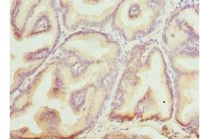 Immunohistochemistry of paraffin-embedded human prostate cancer using ABIN7145599 at dilution of 1:100