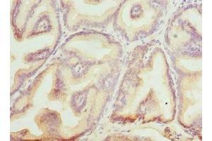 Immunohistochemistry of paraffin-embedded human prostate cancer using ABIN7145599 at dilution of 1:100 (Biliverdin Reductase anticorps  (AA 1-296))