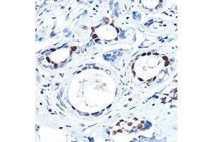 Immunohistochemistry of paraffin-embedded human breast cancer using FOX Rabbit pAb (5278) at dilution of 1:100 (40x lens). (FOXA1 anticorps  (AA 263-472))