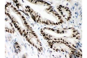 IHC-P: MSH2 antibody testing of human intestine cancer tissue (MSH2 anticorps  (AA 337-583))