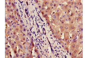 Immunohistochemistry of paraffin-embedded human liver tissue using ABIN7156716 at dilution of 1:100 (ILF2 anticorps  (AA 1-390))