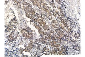 ABIN7094681 and ABIN7098732 at 1/100 staining human colorectal cancer by IHC-P. (SIGLEC9 anticorps  (C-Term))