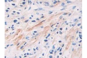 Detection of PIK3Cb in Human Prostate cancer Tissue using Polyclonal Antibody to Phosphoinositide-3-Kinase Catalytic Beta Polypeptide (PIK3Cb)