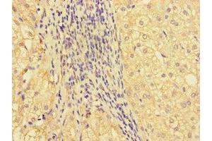 Immunohistochemistry of paraffin-embedded human liver cancer using ABIN7161686 at dilution of 1:100 (GBA2 anticorps  (AA 656-867))