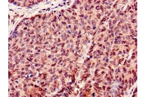 Immunohistochemistry of paraffin-embedded human ovarian cancer using ABIN7155434 at dilution of 1:100