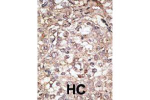 Formalin-fixed and paraffin-embedded human hepatocellular carcinoma tissue reacted with Tlr1 polyclonal antibody  , which was peroxidase-conjugated to the secondary antibody, followed by AEC staining. (TLR1 anticorps  (C-Term))