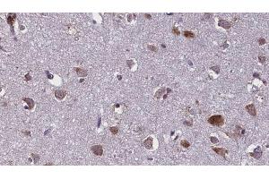 ABIN6274927 at 1/100 staining Human brain cancer tissue by IHC-P. (BCAS4 anticorps)