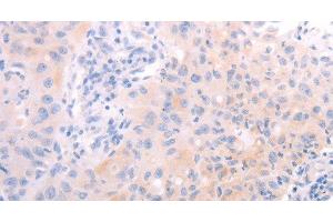 Immunohistochemistry of paraffin-embedded Human lung cancer tissue using AMH Polyclonal Antibody at dilution 1:30 (AMH anticorps)