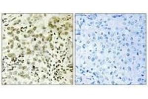 Immunohistochemistry analysis of paraffin-embedded human breast carcinoma tissue, using CTDSP1 antibody.