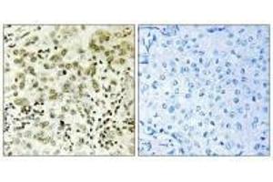 Immunohistochemistry analysis of paraffin-embedded human breast carcinoma tissue, using CTDSP1 antibody. (CTDSP1 anticorps  (N-Term))