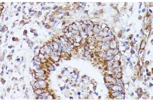Immunohistochemistry of paraffin-embedded Human colon carcinoma using DLAT Polyclonal Antibody at dilution of 1:100 (40x lens).
