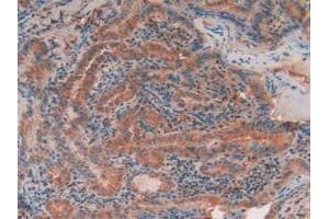 IHC-P analysis of Human Thyroid Cancer Tissue, with DAB staining. (TEK anticorps  (AA 1-116))