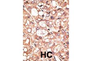 Formalin-fixed and paraffin-embedded human hepatocellular carcinoma tissue reacted with AOF2 polyclonal antibody , which was peroxidase-conjugated to the secondary antibody, followed by DAB staining. (LSD1 anticorps  (Internal Region))