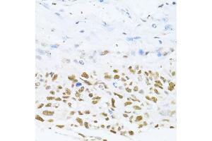 Immunohistochemistry of paraffin-embedded human lung cancer using DNMT1 antibody (ABIN7266810) at dilution of 1:100 (40x lens).