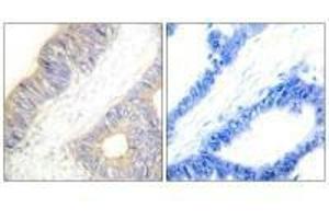 Immunohistochemistry analysis of paraffin-embedded human colon carcinoma tissue using Stefin A antibody.