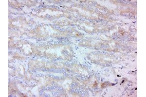 Formalin-fixed and paraffin embedded human lung carcinoma labeled with Anti-MMP-2 Polyclonal Antibody, Unconjugated  at 1:200 followed by conjugation to the secondary antibody and DAB staining.