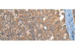 Immunohistochemistry of paraffin-embedded Human liver cancer tissue using C1R Polyclonal Antibody at dilution of 1:40(x200) (C1R anticorps)