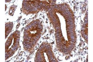 IHC-P Image Immunohistochemical analysis of paraffin-embedded human colon carcinoma, using Vitronectin, antibody at 1:500 dilution. (Vitronectin anticorps)