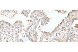 Immunohistochemistry of paraffin-embedded Human thyroid cancer tissue using LSM10 Polyclonal Antibody at dilution of 1:50(x200) (LSM10 anticorps)