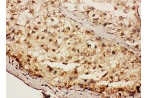 IHC testing of FFPE human liver cancer tissue with SIP antibody. (TSACC/C1orf182 anticorps  (Middle Region))
