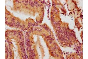 IHC image of ABIN7161004 diluted at 1:100 and staining in paraffin-embedded human endometrial cancer performed on a Leica BondTM system.